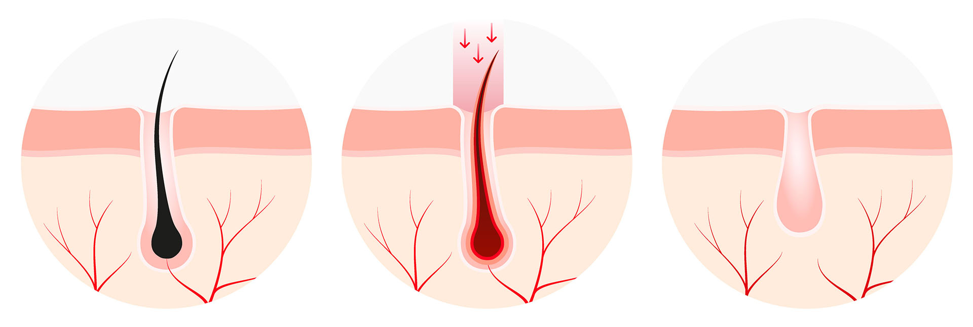 laser hair removal info laser hair removal info